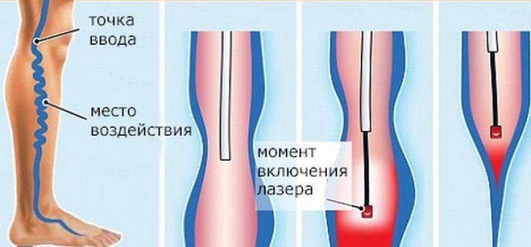 Лечение варикоза без операции в Железнодорожном