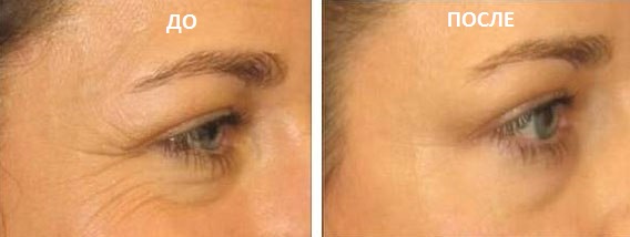 Ботокс в уголки глаз до и после фото